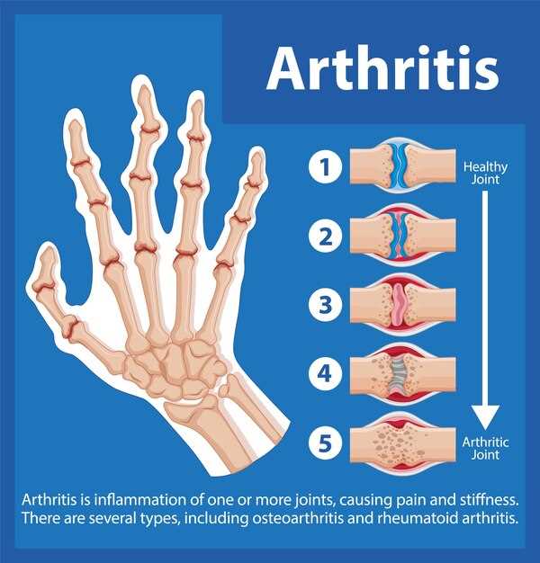 Diclofenac and ibuprofen rheumatoid arthritis